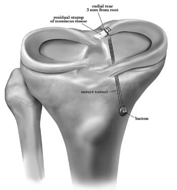 torn meniscus sports medicine sports injury pain meniscus treatment meniscus repair meniscus meniscal root knee pain knee doctor injury  