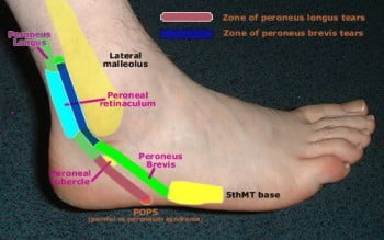sports medicine running injury runner injury peroneal tendons peroneal tendonitis foot ankle  
