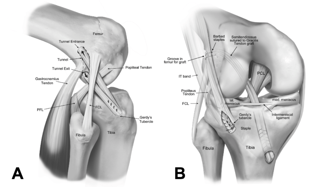 Anterolateral Ligament Anterolateral Complex