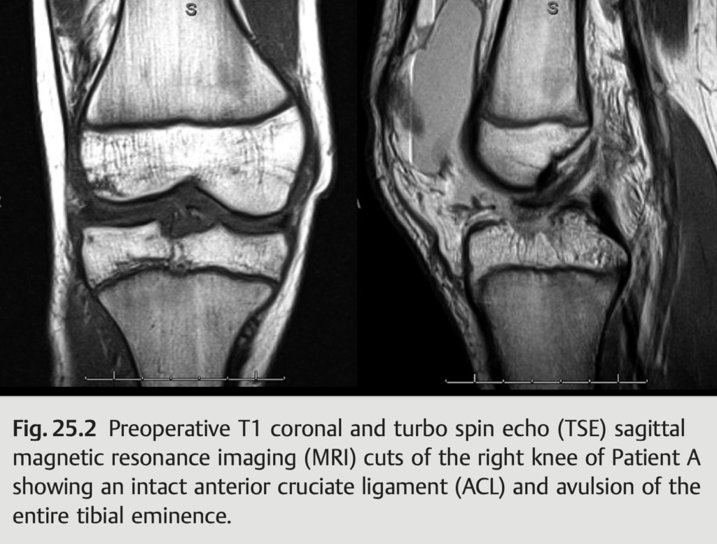 Dr. Burnham Co-Authors Book Chapter On Pediatric Acl Injuries | Book Chapter On Pediatric Acl Injuries Book Chapter On Pediatric Acl Injuries