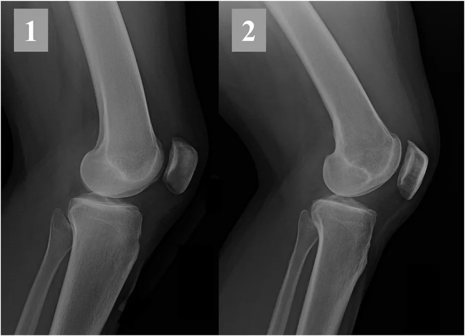 Medical Records Review For Legal Cases | Standing Knee Radiograph Showing Joint Space Narrowing And Degenerative Changes, Illustrating The Imaging Modality Limits Described In Duncan-Burnham 2015 Systematic Review Of Standing Radiograph Sensitivity For Knee Osteoarthritis