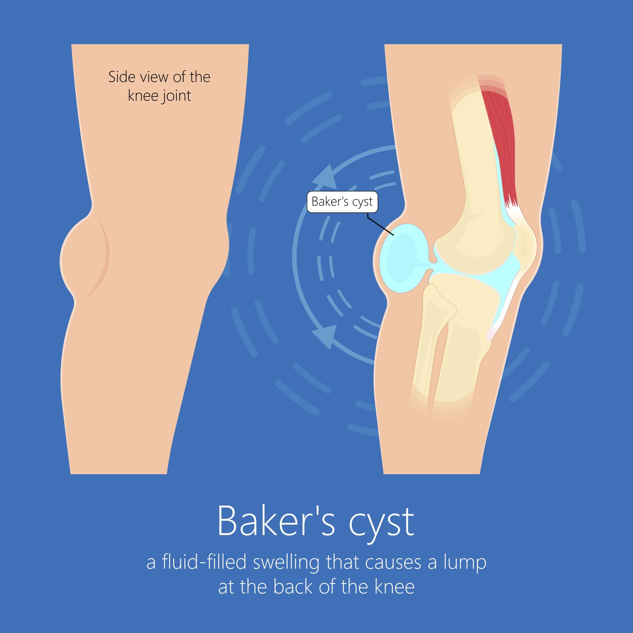 Baker39s Cyst A Lump Behind The Knee Sports Injury Online