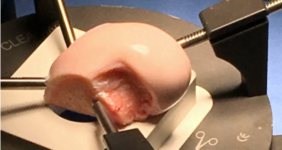 biouni-cartilage-replacement-cartilage-reconstruction